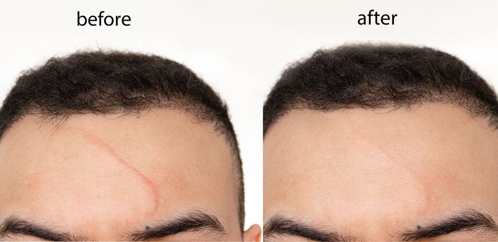 Minimize the Appearance of Scars with Scar Revision at Dr Singh’s City Hospital Kalamboli