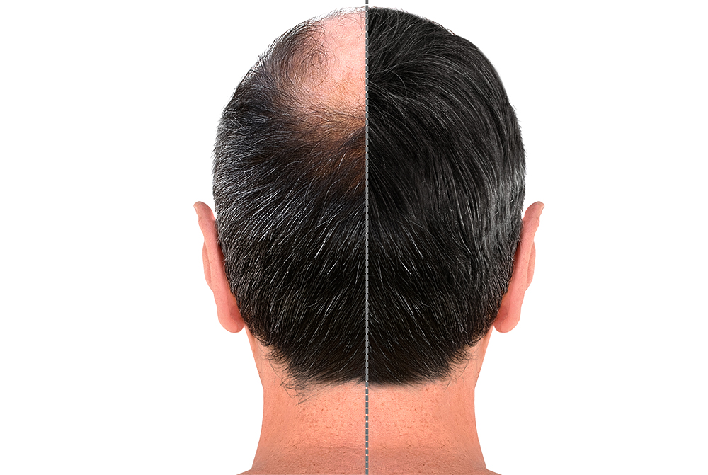 Regain Your Confidence with Hair Transplant at Dr Singh’s City Hospital Kalamboli